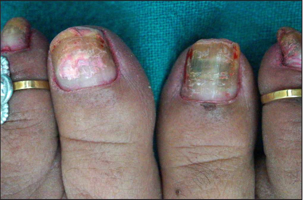Left toe with whitish keratin degranulation and right toe with greenish-yellow discoloration due to pseudomonas infection