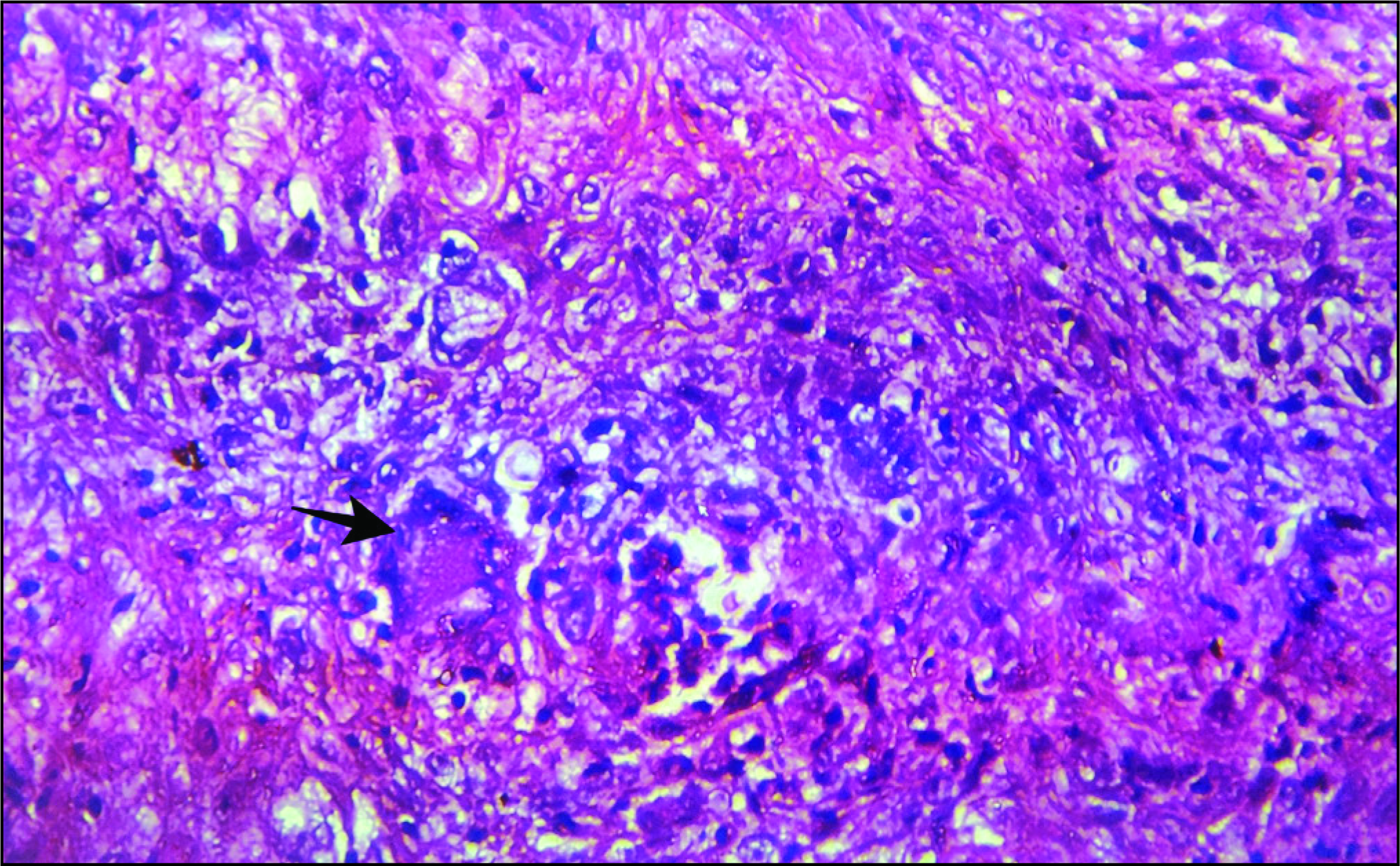 Cellular infiltrate with giant cell (indicated by arrow), epithelioid cells and lymphocytes (H &E, 400x).