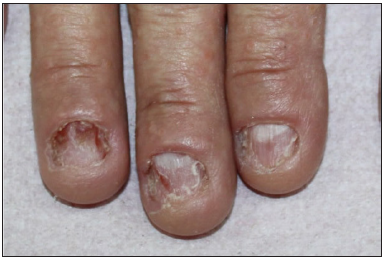 Nail changes at presentation; longitudinal red bands, ridging and dystrophic nail plate.