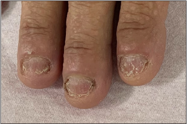 Improvement of nail signs 12 months after apremilast initiation.