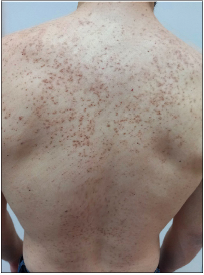 Red-brown hyperkeratotic papules on the shoulders and back, at presentation.