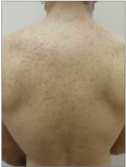 Improvement in lesions 7-months after the initiation of apremilast.