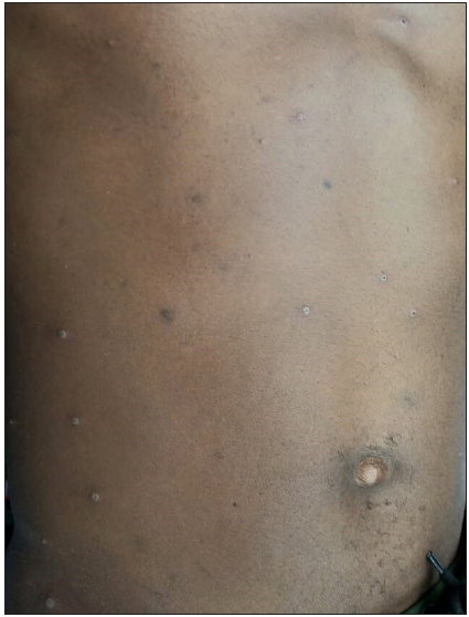 Few scattered umbilicated papules present over the chest and abdomen.