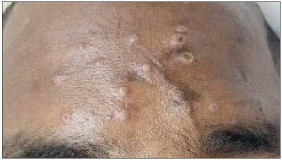 Multiple skin-coloured, umbilicated papules and vesiculopustular lesions present over the forehead.