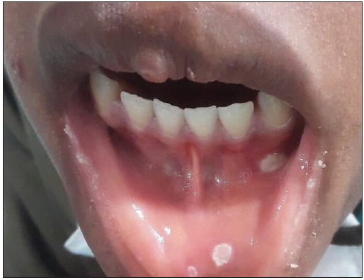 Multiple skin-coloured umbilicated papules present over the oral mucosa with overlying greyish slough.