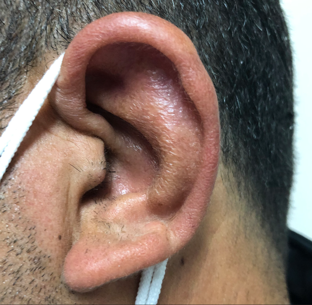 Complete cure of the auricular cutaneous leishmaniasis after receiving 14 intralesional injections of meglumine antimoniate