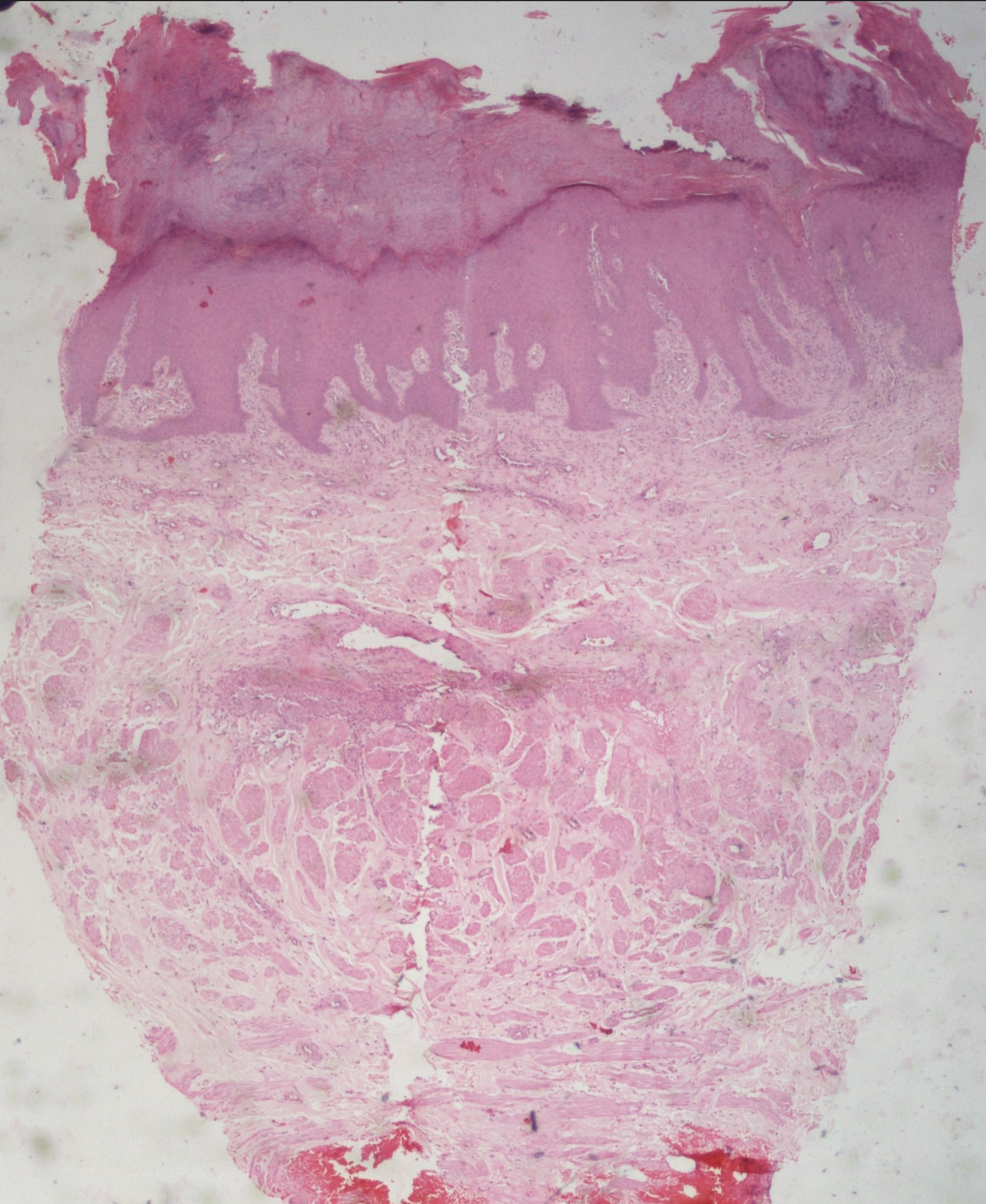 Massive hyperkeratosis, parakeratosis, irregular acanthosis, papillary dermal fibrosis, increased capillary proliferation in the papillary dermis, a perivascular lymphohistiocytic infiltrate, suggestive of prurigo nodularis (H & E ×20)