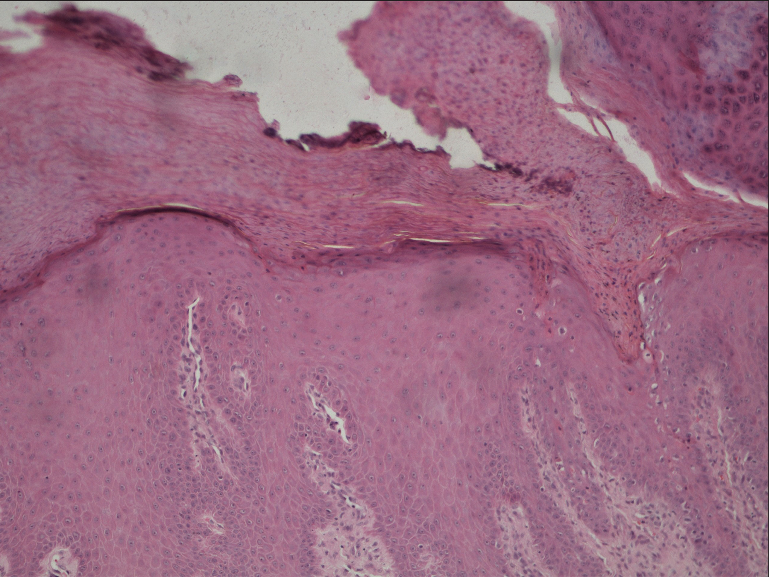 A vertically oriented parakeratotic column invaginating into the epidermis with underlying dyskeratotic cells suggestive of cornoidlamellation (H & E ×100)
