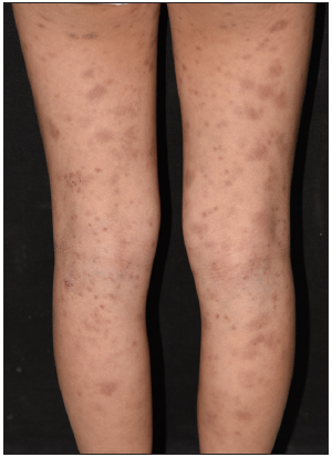 Multiple symmetrically distributed larger polygonal pigmented macules of urticaria pigmentosa on the legs.
