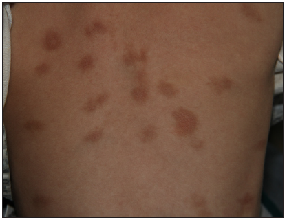 Multiple large round to polygonal variably shaped pigmented macules of urticaria pigmentosa on the back.