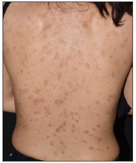 Multiple variably sized pigmented macules of urticaria pigmentosa on the back.