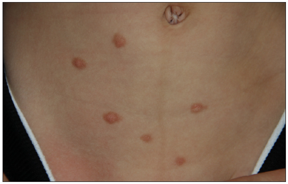 Yellowish orange to red brown elevated papules of urticaria pigmentosa on the abdomen.