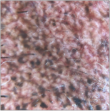 Pre-treatment: Dermoscopy showed irregular, dark brown to black globular, annular and arciform structures forming a curvilinear and worm-like pattern on telangiectatic background (DermLite DL4, polarised mode, 20x).