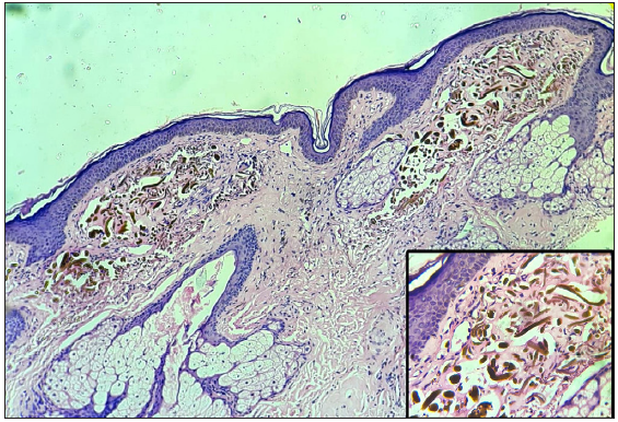Thinned-out epidermis, elastotic degeneration in the superficial dermis along with the deposition of extracellular, yellowish-brown, banana-shaped, sickled or round ochronotic bodies, (Haematoxylin and Eosin, 40x) better visualised in inset image (Haematoxylin and Eosin, 400x).