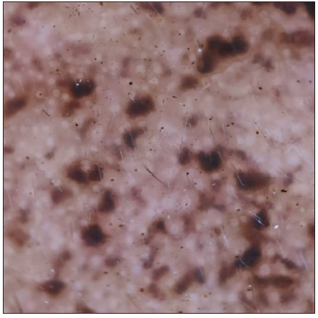 Three months post-treatment: Dermoscopy showed few and smaller dark brown to black globular, annular and arciform structures along with subsidence of telangiectasia in the background (DermLite DL4, polarised mode, 20x).