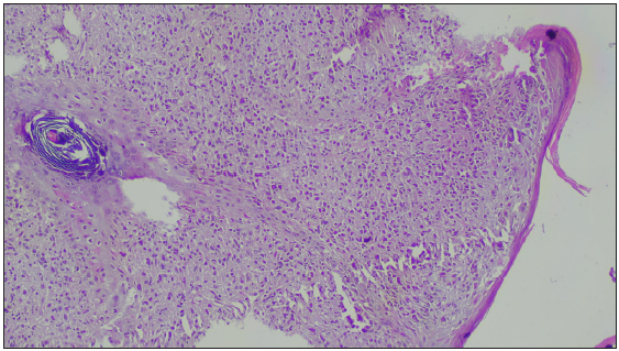 Diffuse infiltration by histiocytes exhibiting focal storiform pattern (Haematoxylin and Eosin, 100x).
