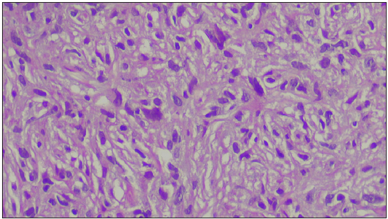 Mononuclear histiocytic cell proliferation seen in the dermis (Haematoxylin and Eosin, 400x).