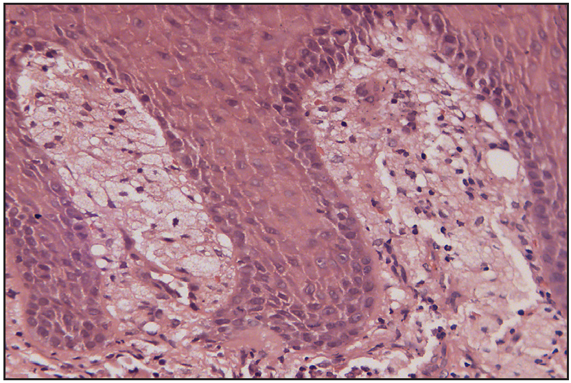 Multiple foamy histiocytes present within the dermal papillae (H&E, 400X)