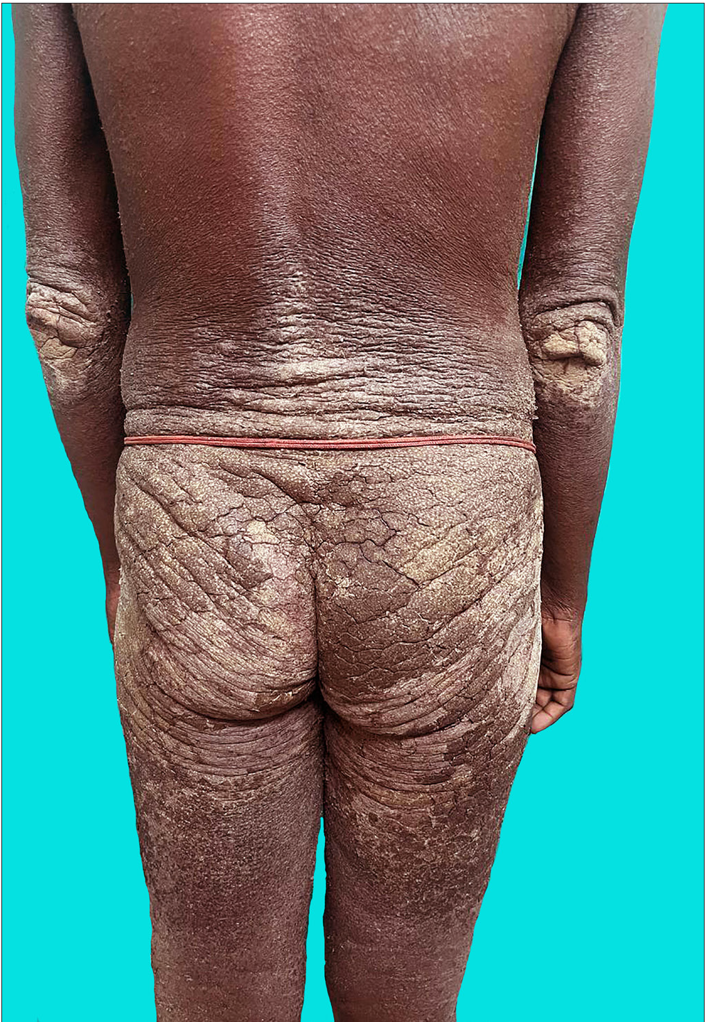Multiple hyperkeratotic and crusted plaques with fissures noted over back, buttocks and bilateral elbows