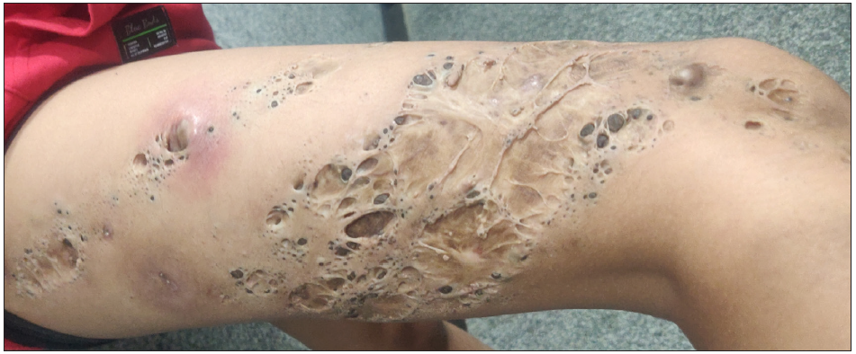 Naevus comedonicus over the right thigh in an 18-year-old boy showing giant comedones.