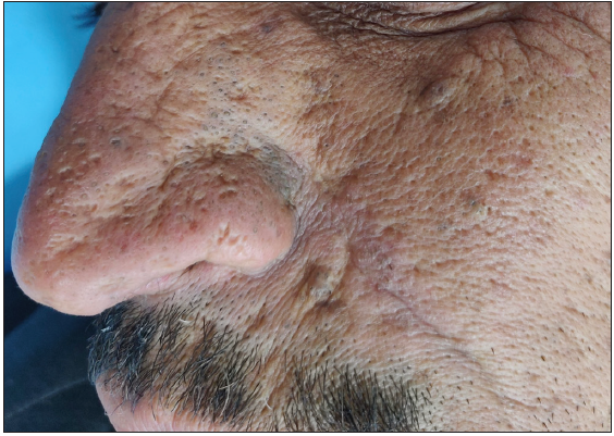 Actinic comedonal plaques over the nose in a 70-year-old man.