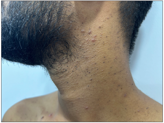 Dowling-Degos disease presenting as hyperpigmented macules and keratotic papules over the neck.