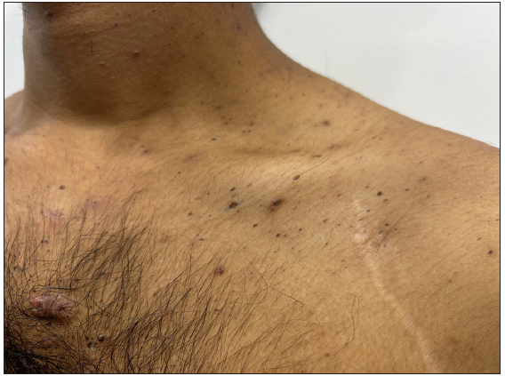 Dowling-Degos disease presenting as comedo-like lesions over the upper chest.