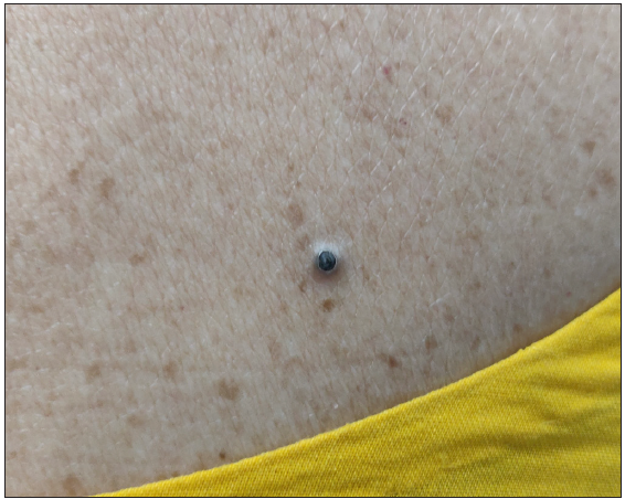Dilated pore of Winer on the upper back in a 38-year-old woman.