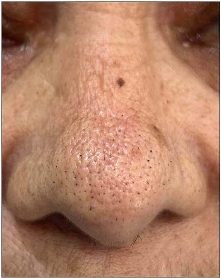 Trichostasis spinulosa presenting as comedo-like lesions over the nose in a 60-year-old woman.