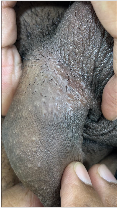 Penile acne in a 21-year-old man.