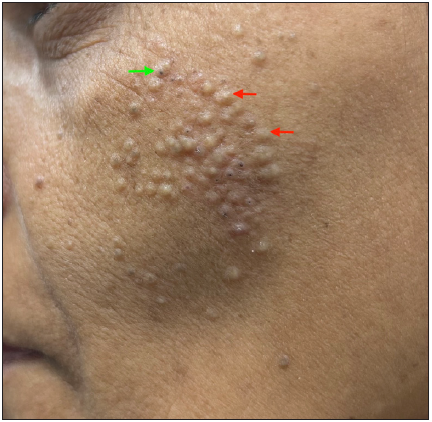 Primary comedones presenting as multiple closed comedones (red arrows) and a few open comedones (green arrow) over the left cheek of a young woman.