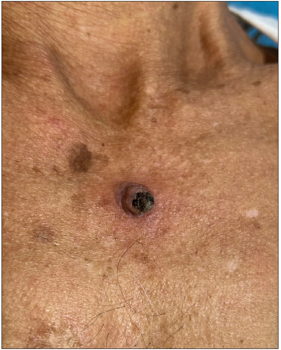 Keratoacanthoma over the chest in a 72-year-old man.