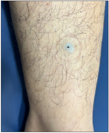 Epidermoid cyst with a central comedo-like punctum over the leg in a young woman.