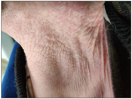 Comedones within plaques of pseudoxanthoma elasticum in a 29-year-old man.