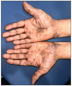 Palmoplantar lichen planus featuring hyperkeratotic papuloplaques with central keratotic plugs over bilateral palms.