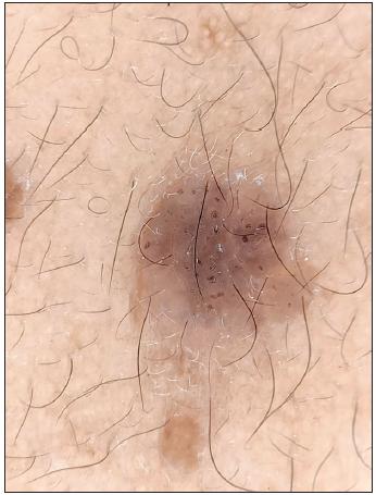 Polarised dermoscopy showing comedo-like lesions in seborrheic keratosis (Heine Delta 20 Dermatoscope, Heine Optotechnik Gilching, Germany; 10x).