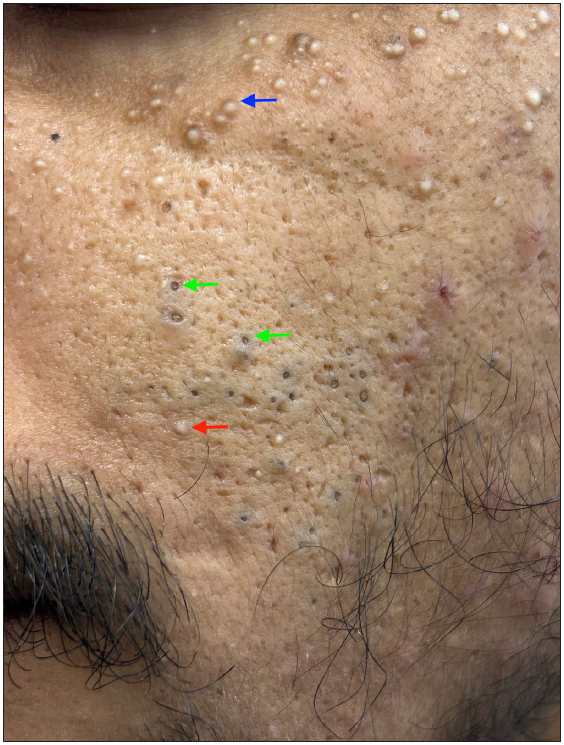 Multiple open comedones (green arrows), a few closed comedones (red arrow) along with milia (blue arrow) over the left cheek of a young man.