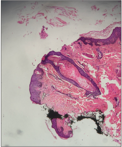Histology of a closed comedone showing a dilated follicular canal filled with a compact mass of keratinous material (Haematoxysin and Eosin; 100x).