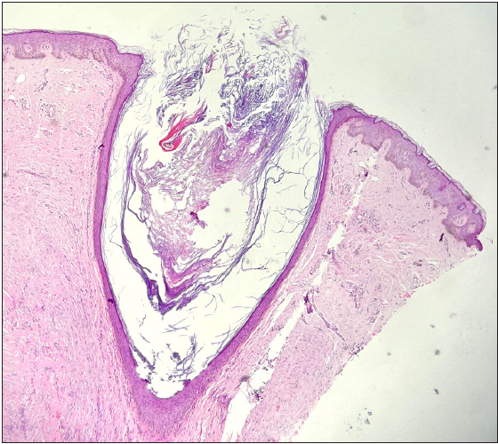 Histology of an open comedone showing massive follicular dilation that opens to the epidermis. The cavity is filled with keratinous and cellular debris (Haematoxysin and Eosin; 100x).