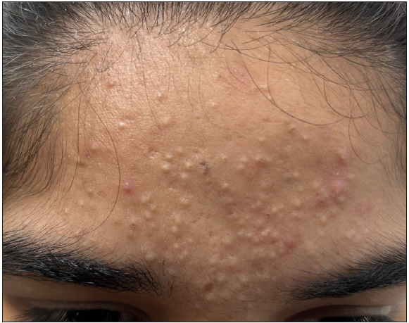 Sandpaper comedones over the forehead in a 16-year-old girl with acne.