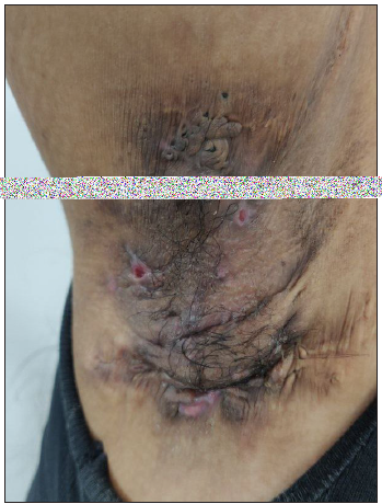 Polyporous comedones over the right axilla in a young woman with hidradenitis suppurativa.