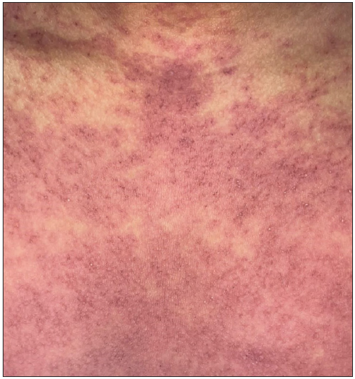 Purpuric rash in a patient with azithromycin-induced drug reaction with eosinophilia and systemic symptoms.