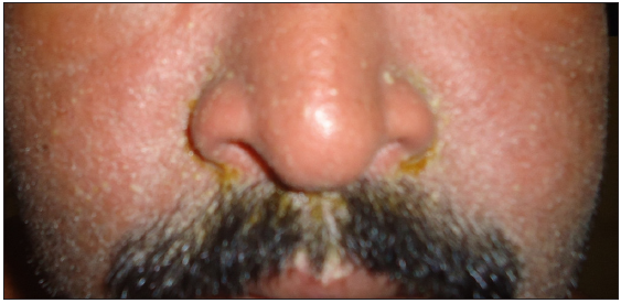 Oedema, erythema and scaling of face in a patient with cefixime-induced drug reaction with eosinophilia and systemic symptoms.