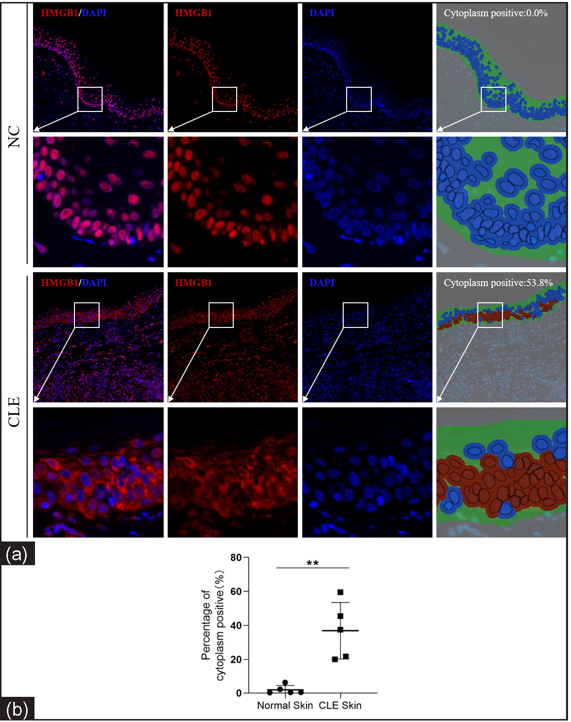 Nuclear-cytoplasmic localization expression of HMGB1 in the epidermis of CLE patients (n = 5) and healthy controls (n = 5; IHF, 200×). HMGB1 staining is shown in red and nuclear DAPI staining is shown in blue. The irregular green part of cytoplasm positive indicates the epidermis and the red circle indicates the HMGB1 expression localised in the cytoplasm after analysis using Inform software (**P < 0.01).