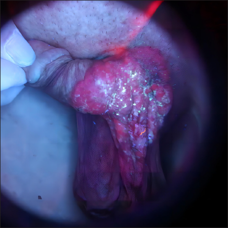Photodynamic diagnosis under Wood’s light with brick red fluorescence observed on the pubic mound, penile, and upper scrotum.