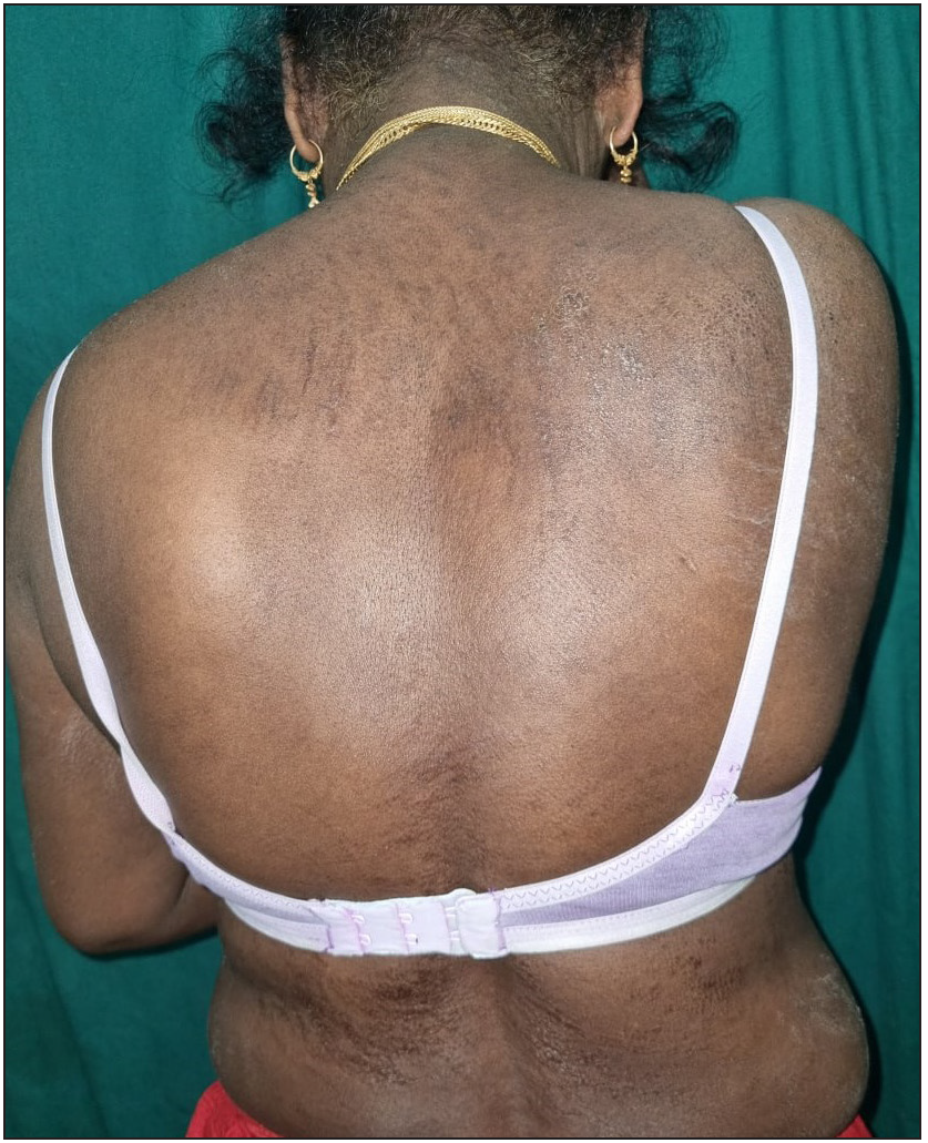 Disseminated hair dye dermatitis in a 32-year-old female. Patch test was positive for para-phenylenediamine. A differential diagnosis of seborrheic dermatitis and photo-allergic contact dermatitis were also considered.