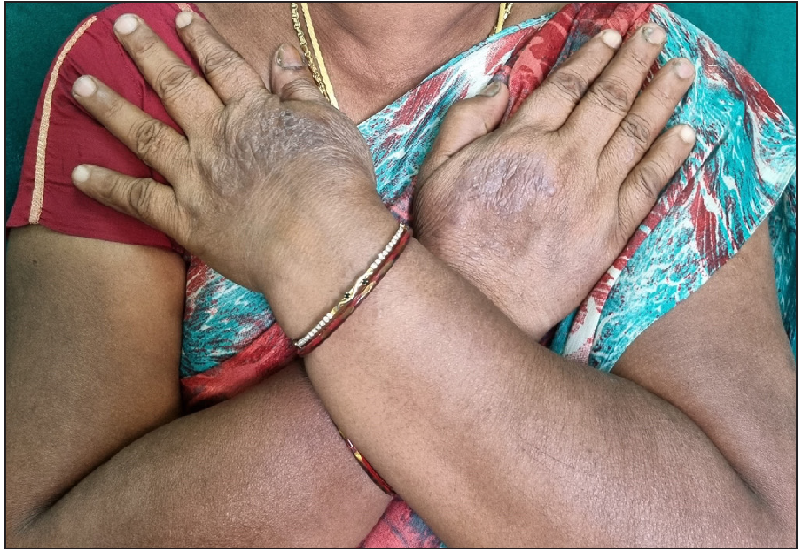 Hairdresser with allergic contact dermatitis on the dorsa of hands. She showed a positive reaction to para-phenylenediamine on patch testing. A differential diagnosis of polymorphous light eruption was considered.