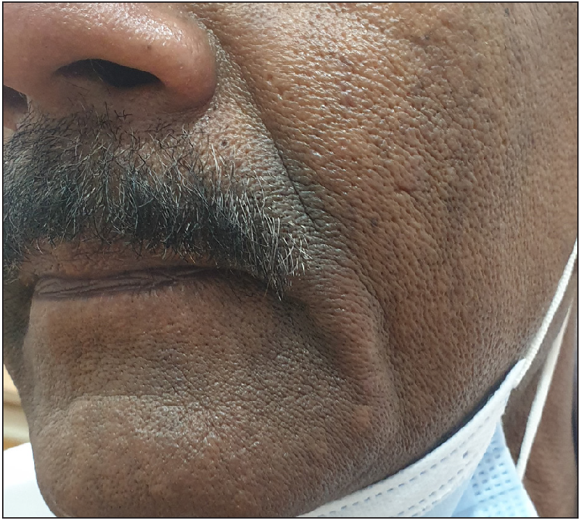 Pigmentary contact dermatitis over the moustache region.