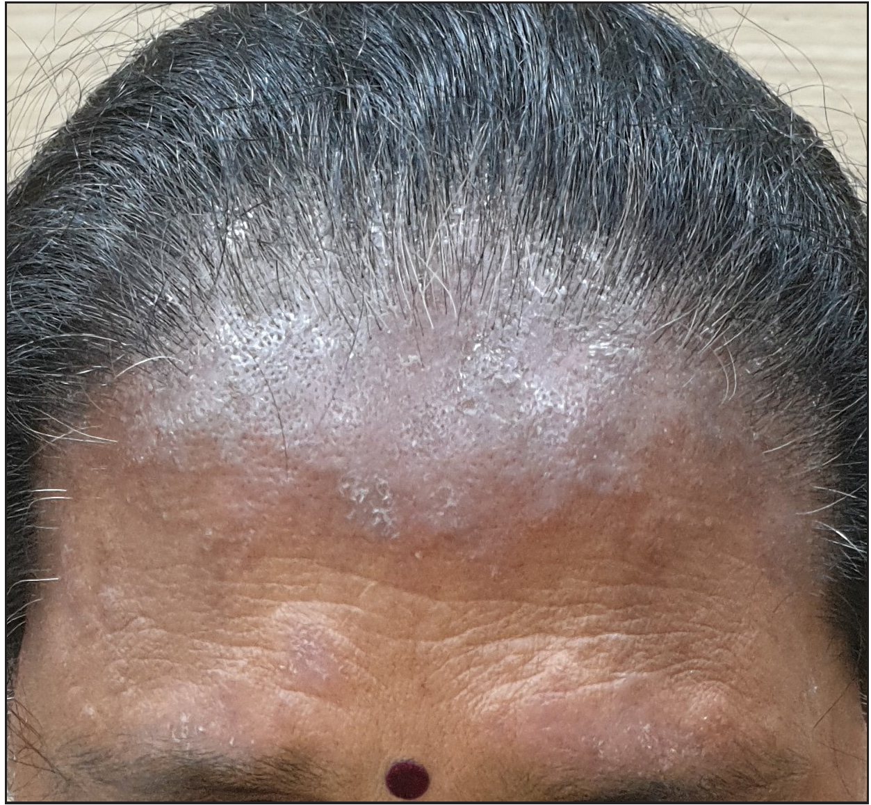 Allergic contact dermatitis to hair dye extending from anterior hairline to forehead.