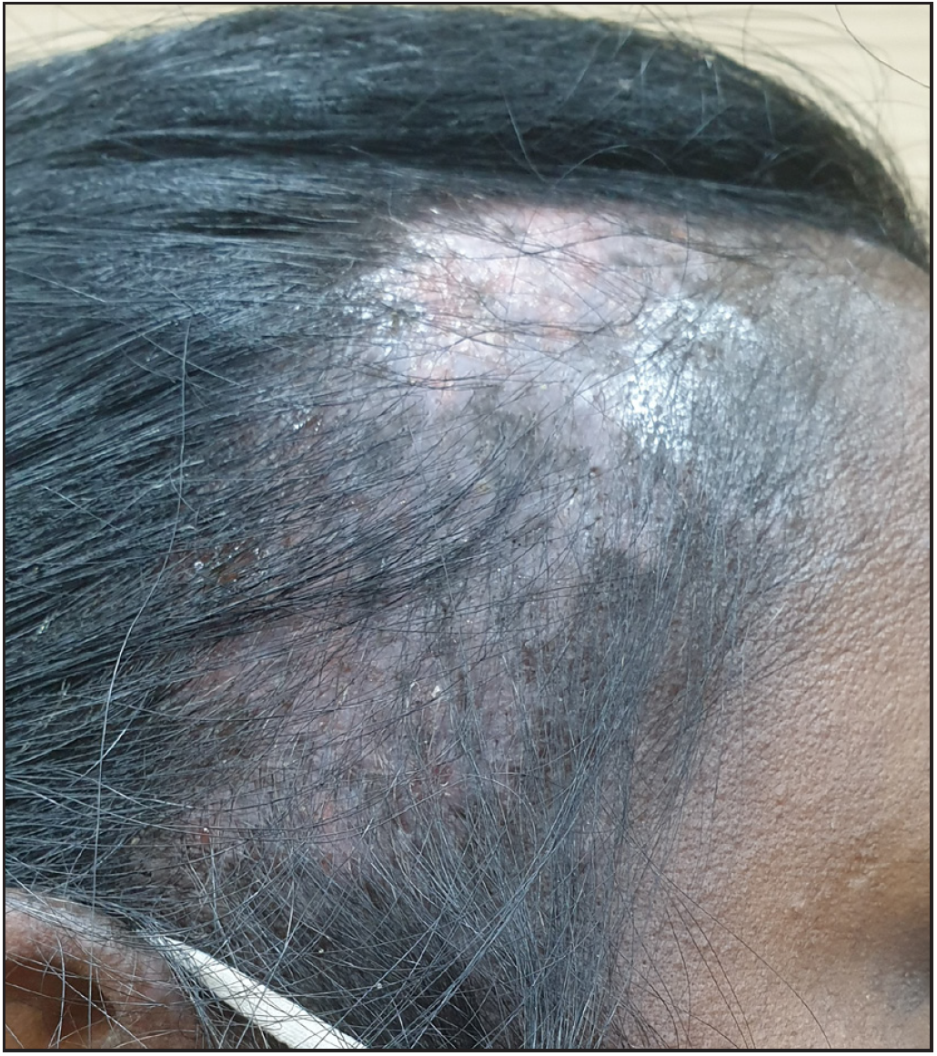 Allergic contact dermatitis associated with hair loss following hair dye use.